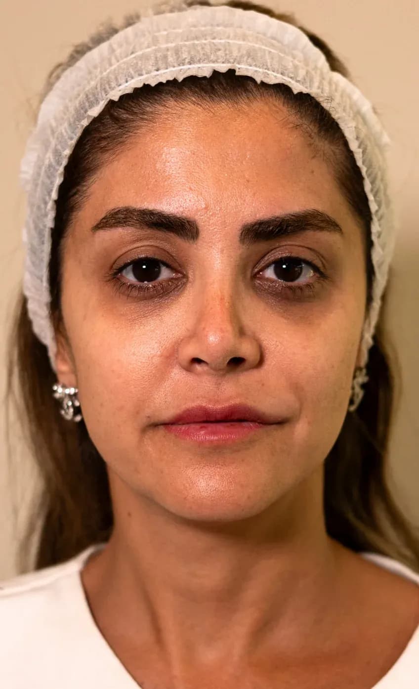 Signature Skin Booster Result before treatment