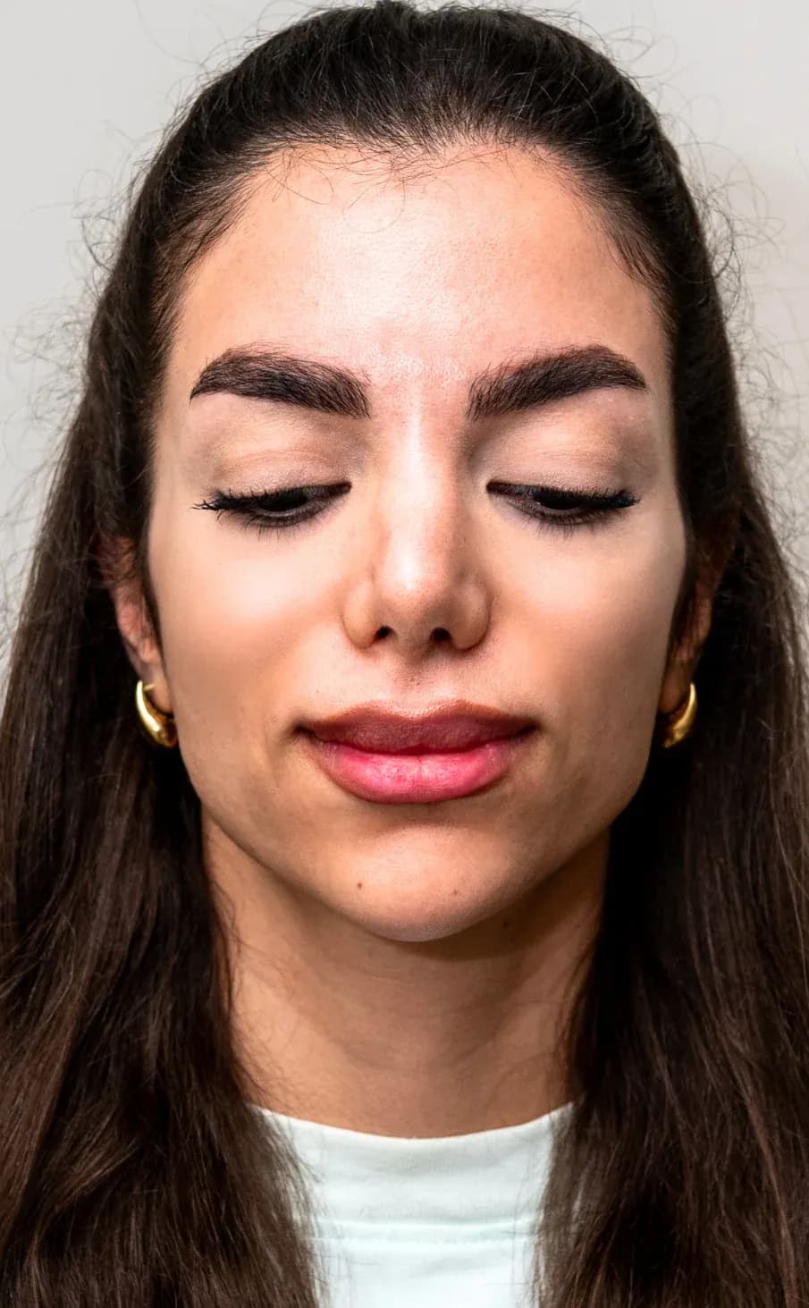 Signature Midface Filler Result after treatment