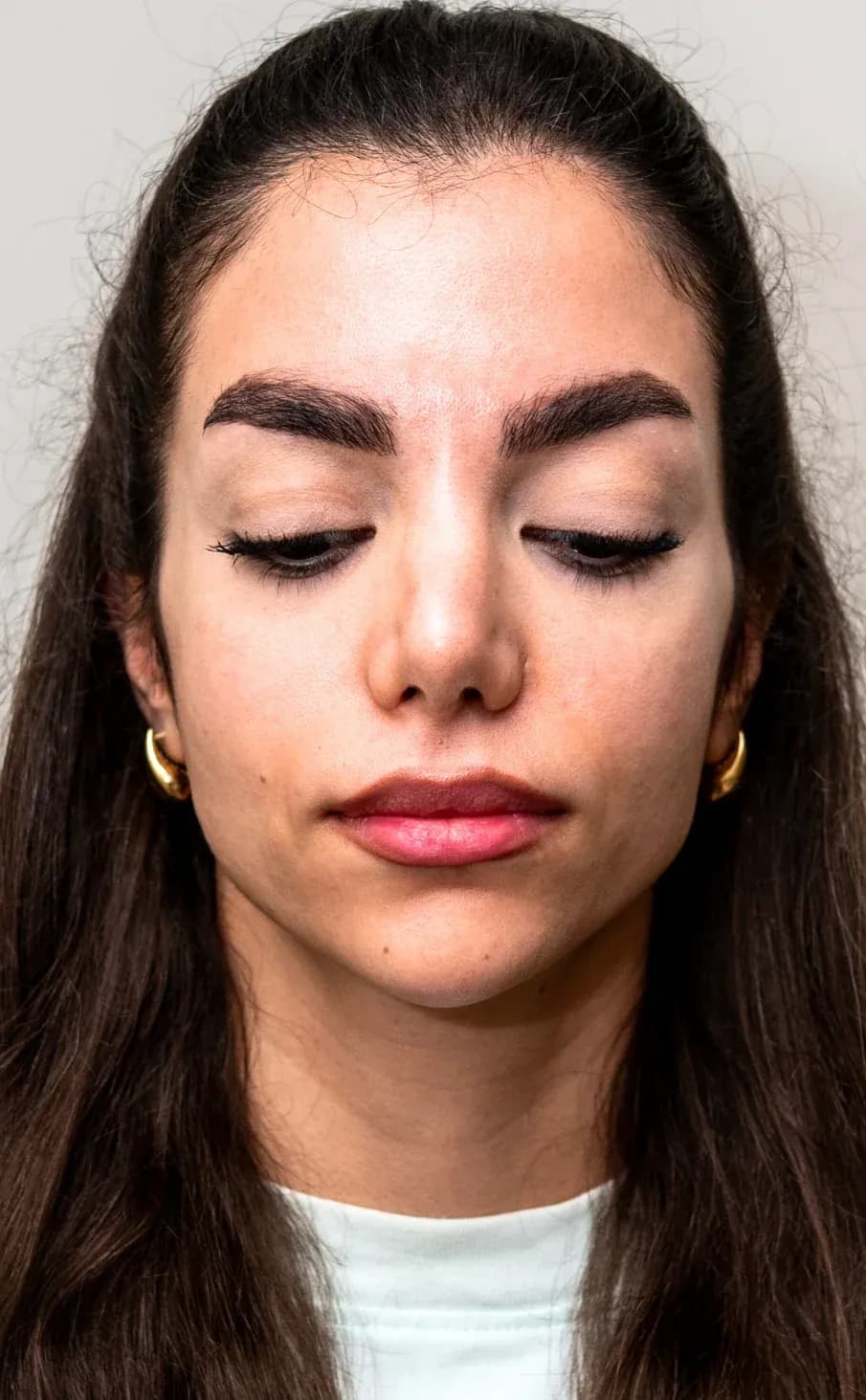 Signature Midface Filler Result before treatment