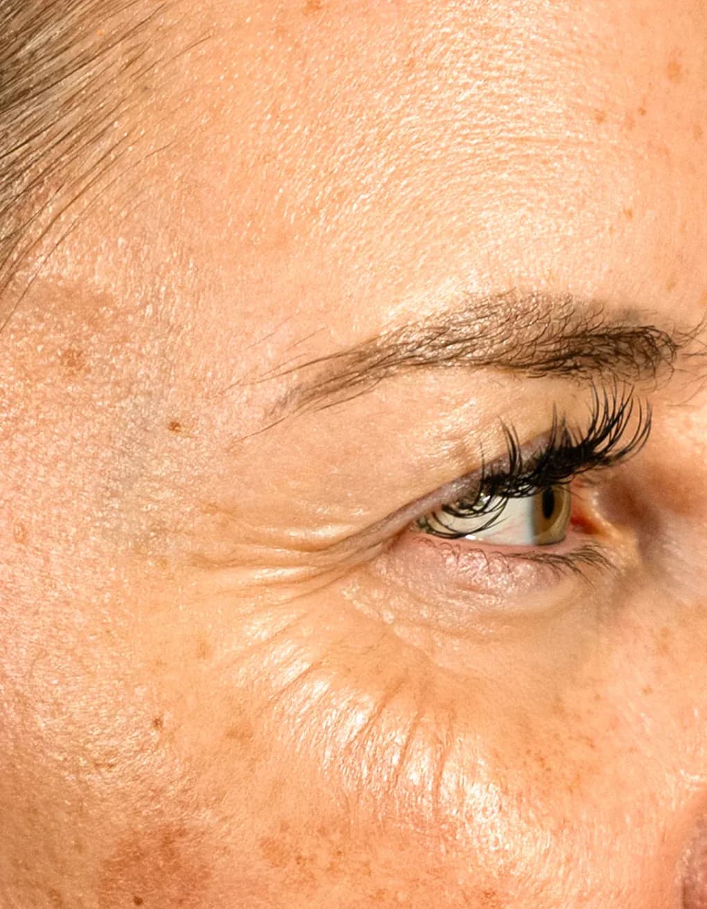 Fotona Eye Wrinkle Rejuvenation before treatment