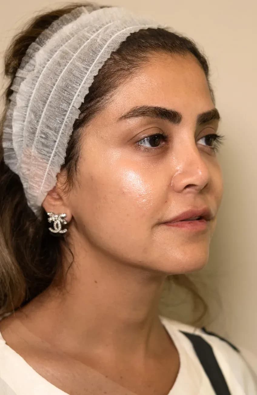 Signature Booster Profile Result after treatment