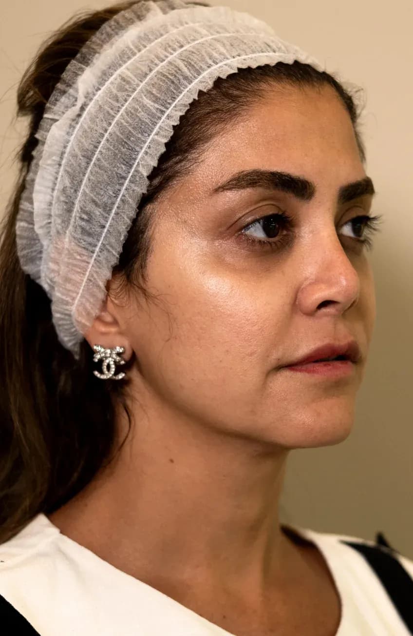 Signature Booster Profile Result before treatment