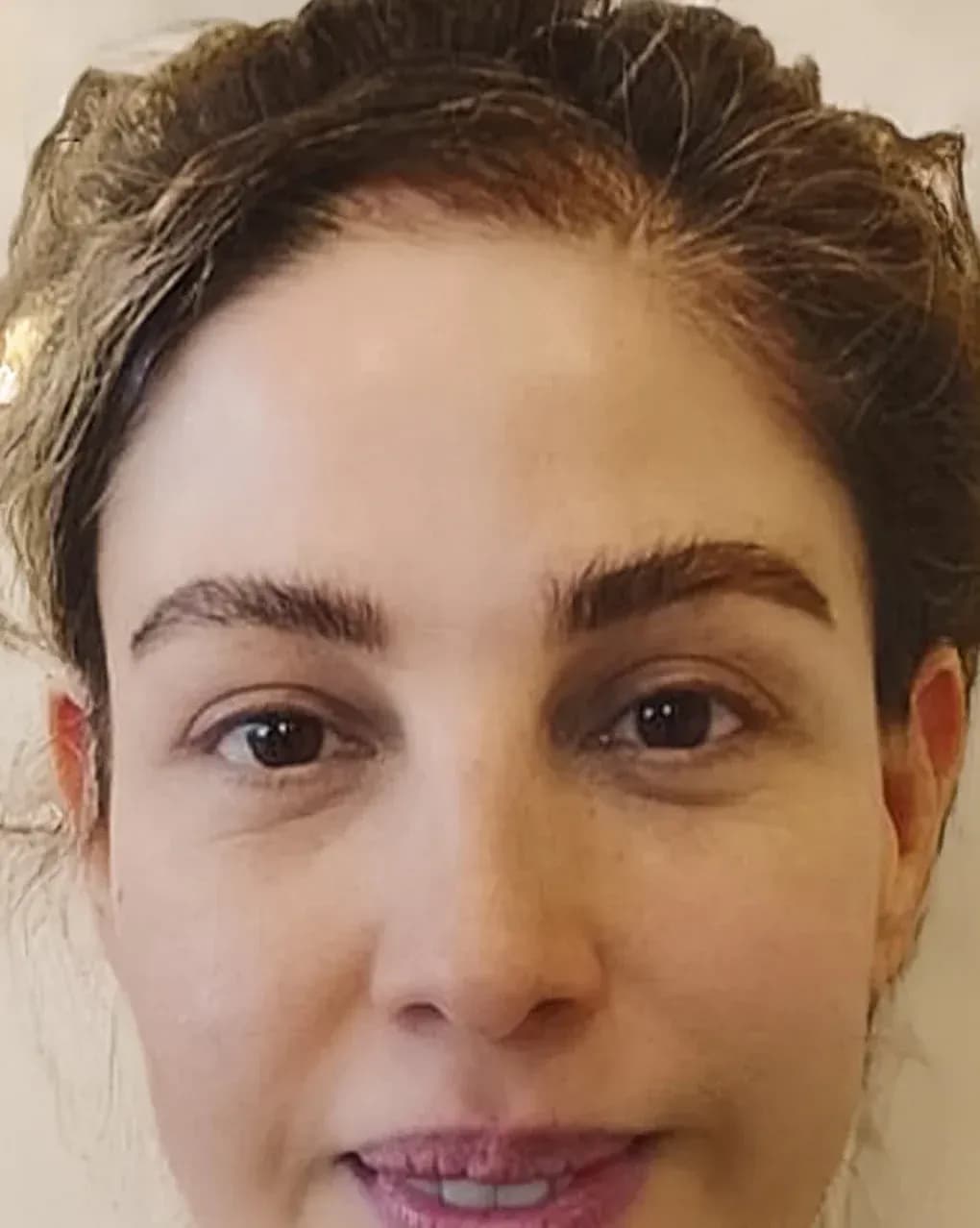 Signature Rejuvenation Result after treatment