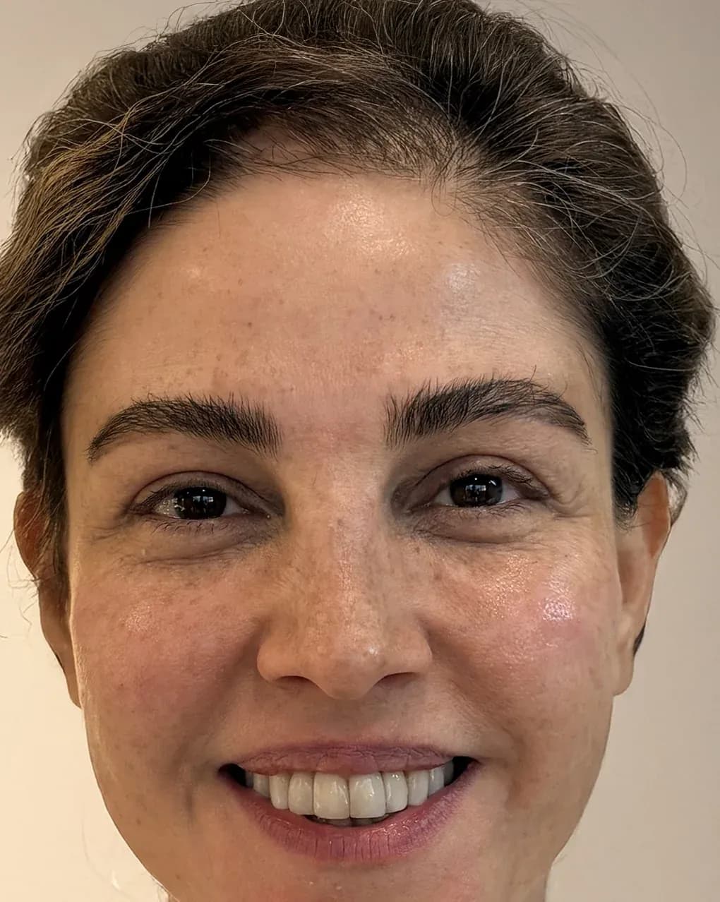 Signature Rejuvenation Result before treatment
