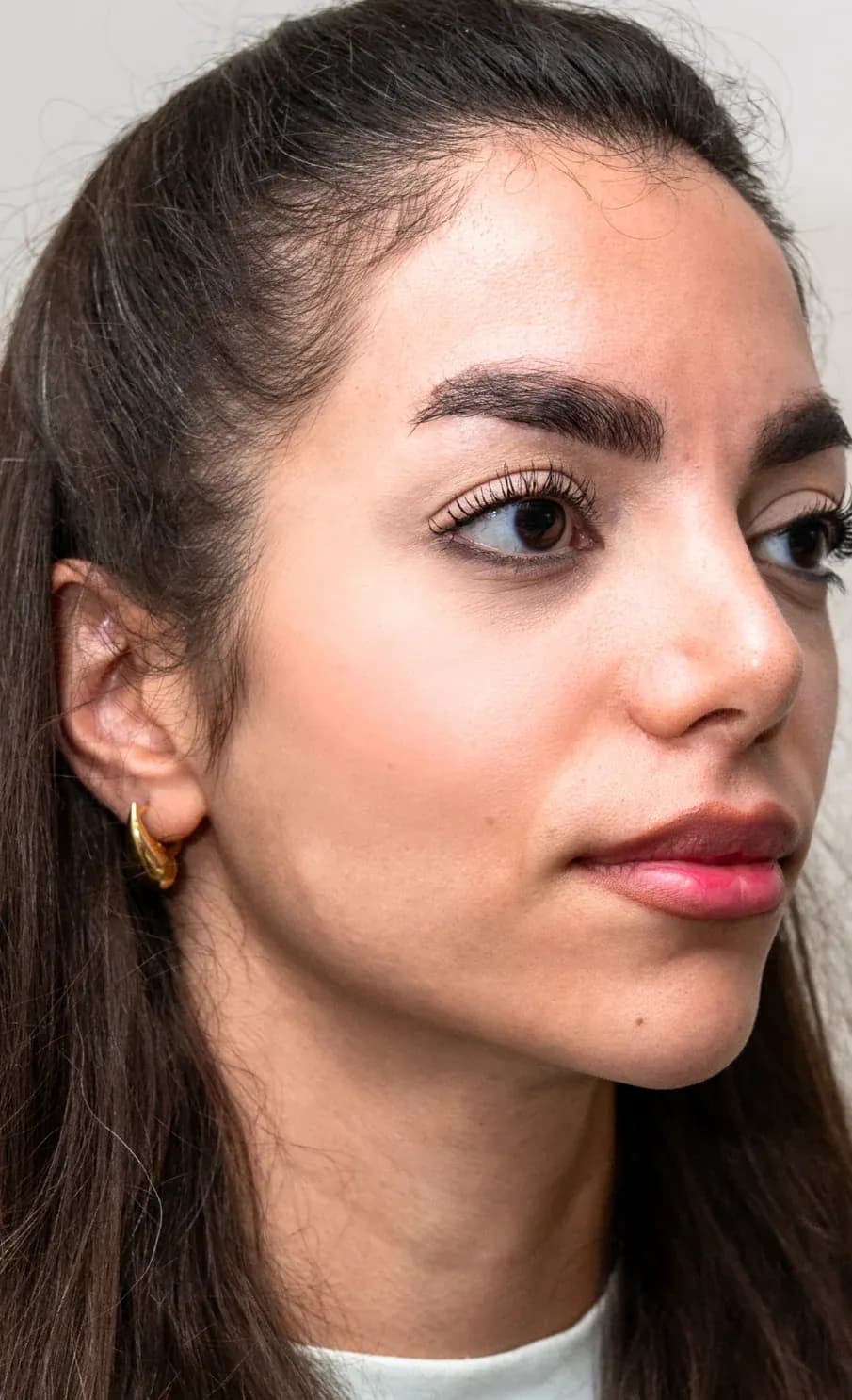 Signature Midface Filler Profile after treatment
