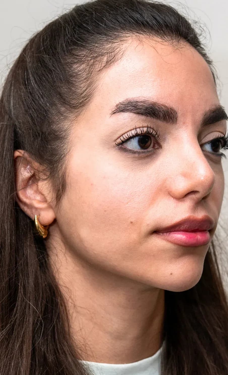 Signature Midface Filler Profile before treatment