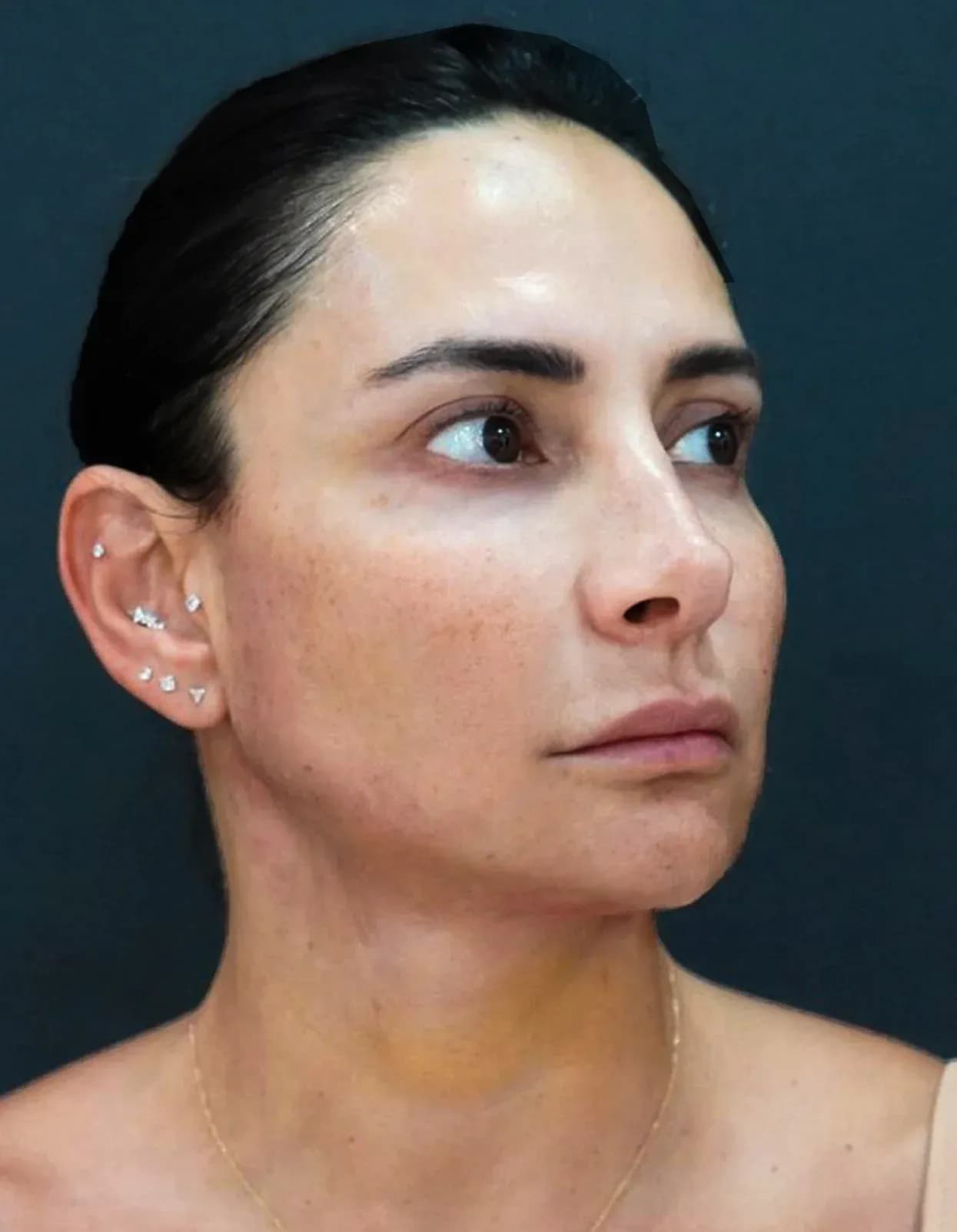 Korean Lift Facial Contouring after treatment