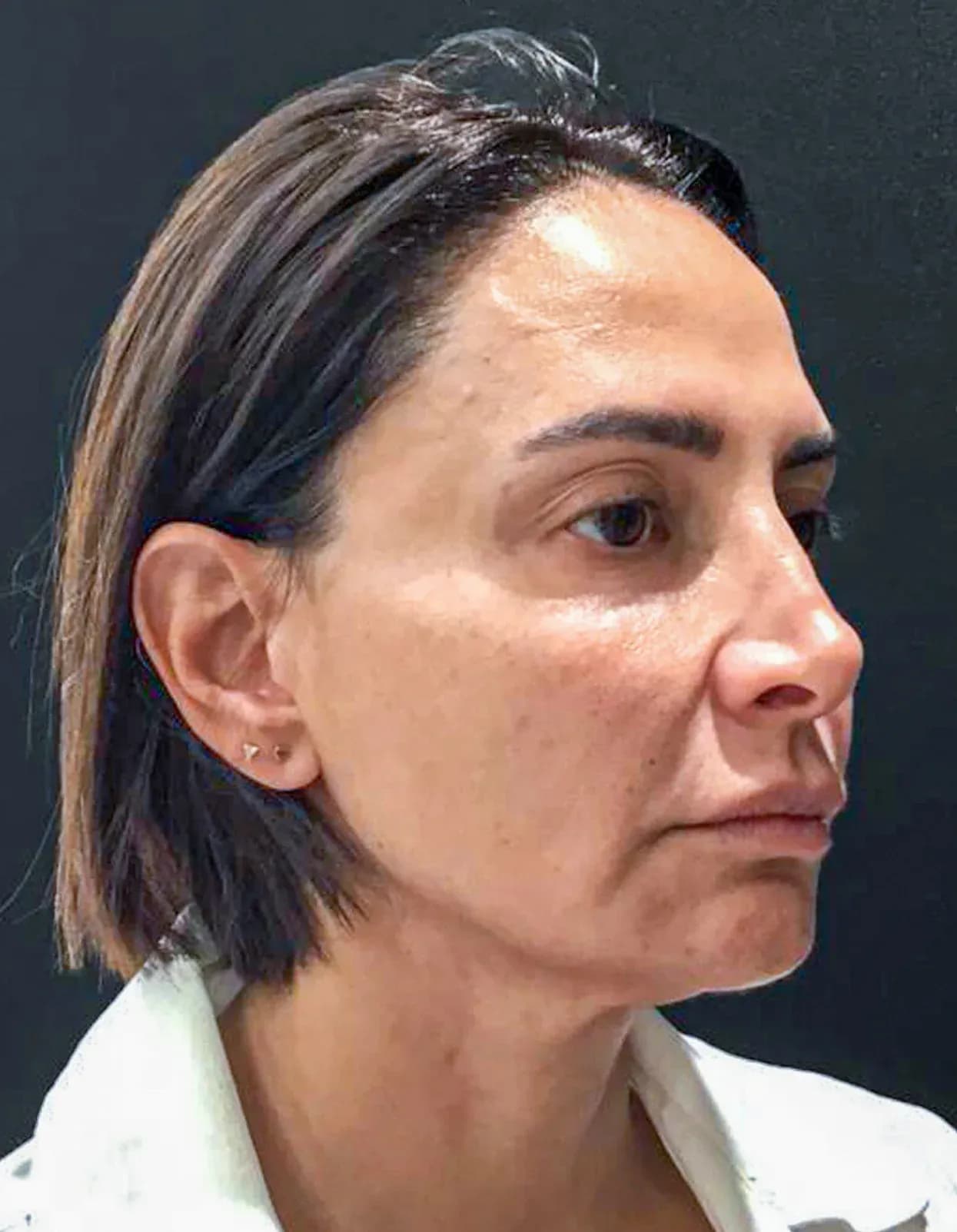 Korean Lift Facial Contouring before treatment