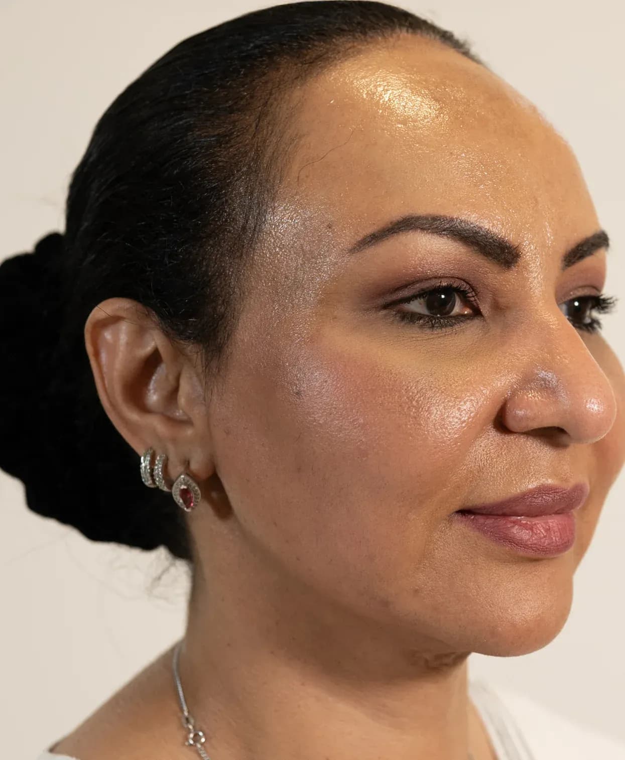 Korean Lift Profile Refinement after treatment