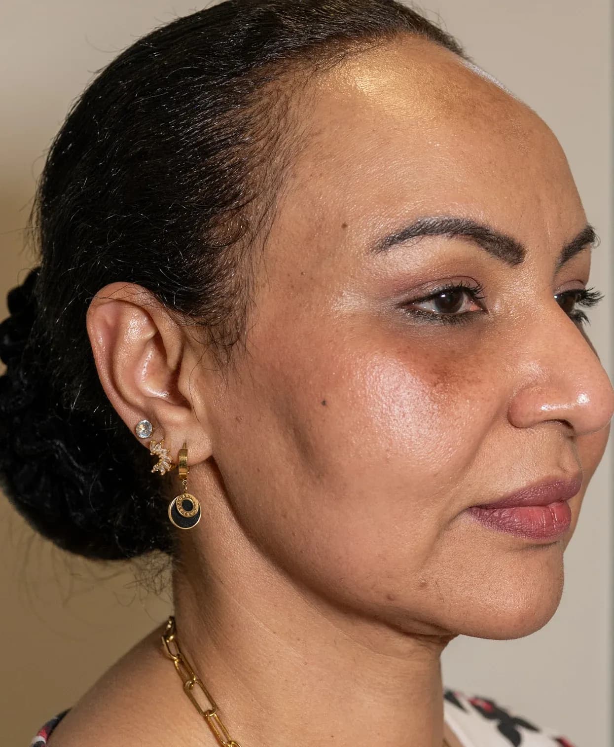 Korean Lift Profile Refinement before treatment