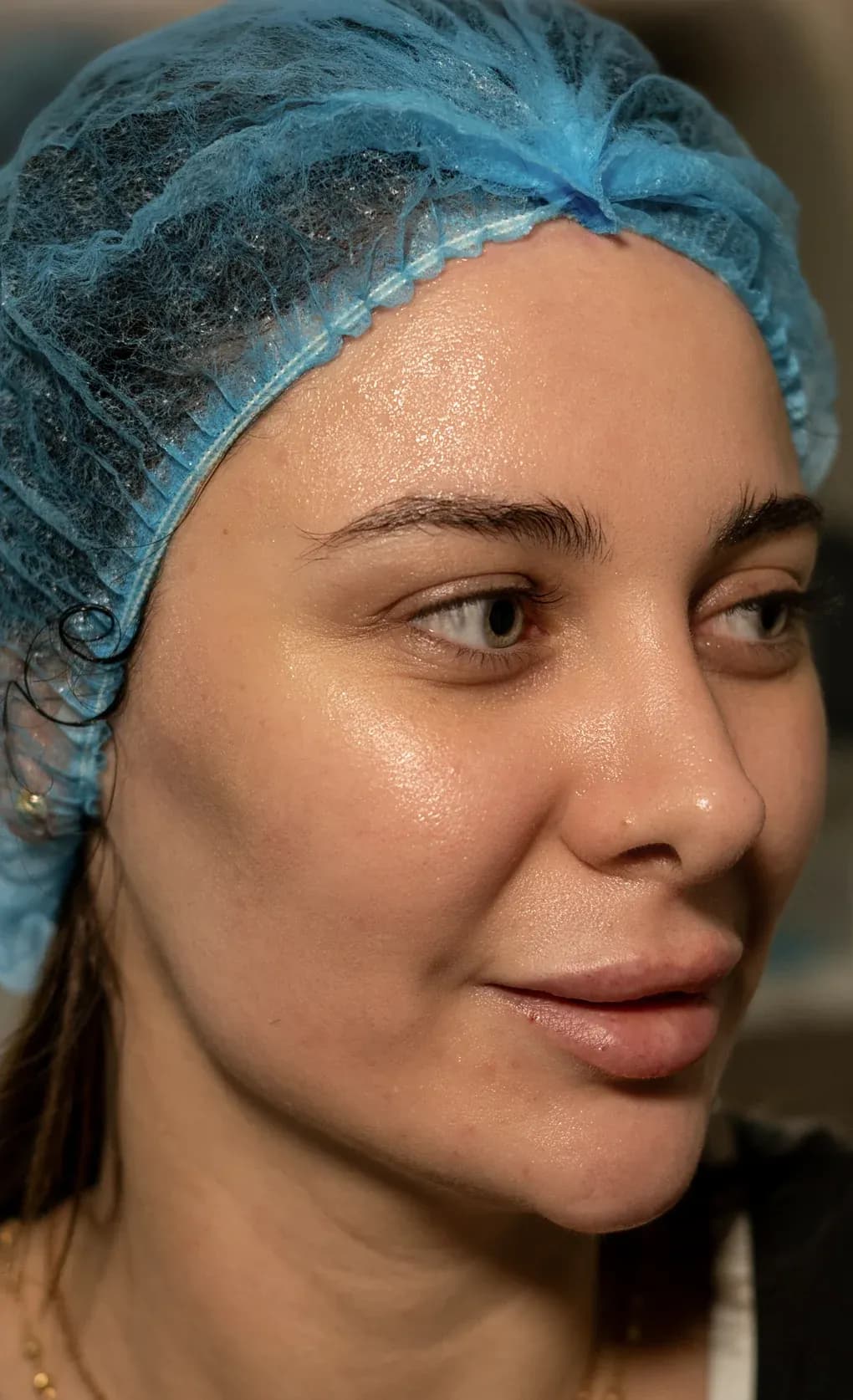 Derma Facial Skin Refresh after treatment