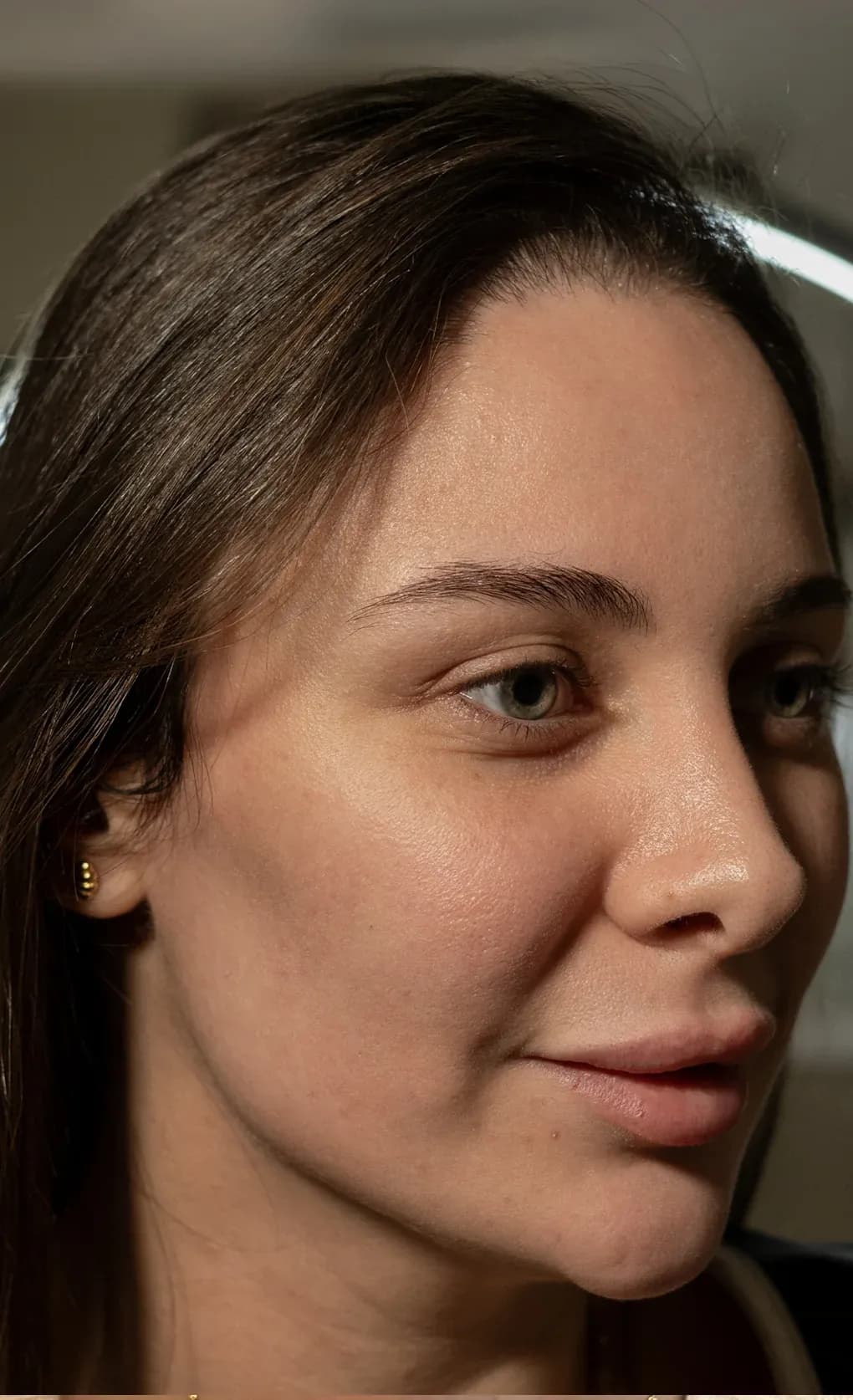 Derma Facial Skin Refresh before treatment