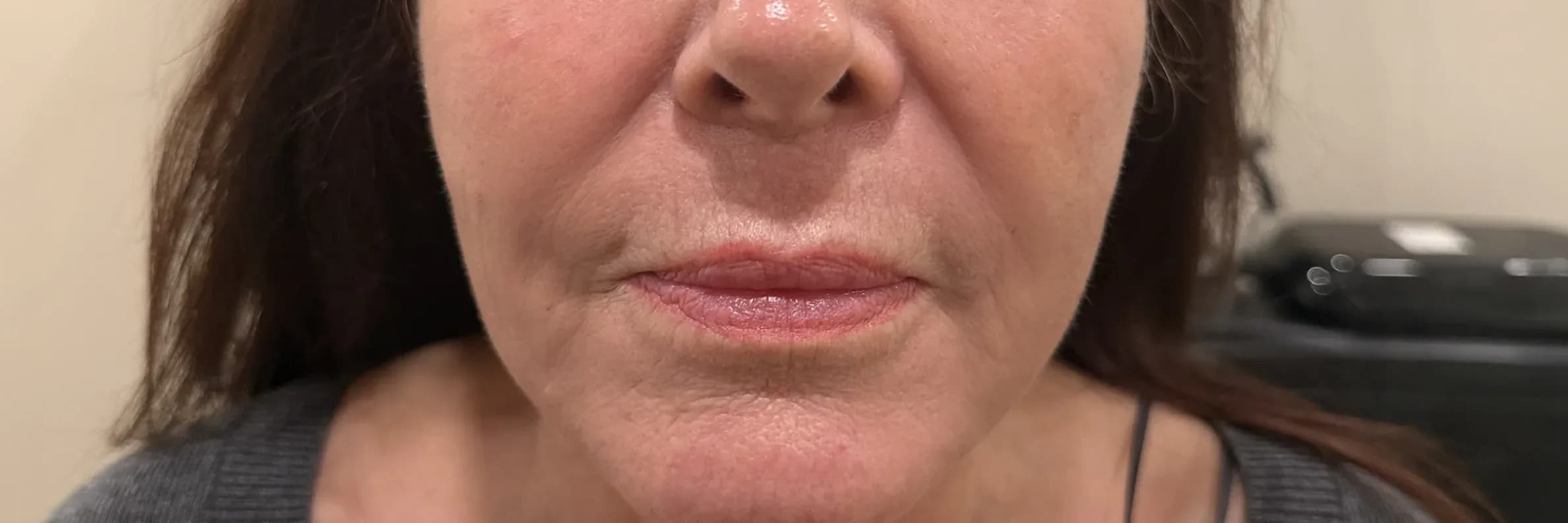 Fotona 7D Lower Face Rejuvenation after treatment