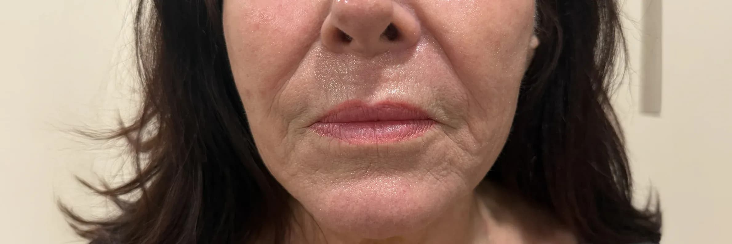 Fotona 7D Lower Face Rejuvenation before treatment