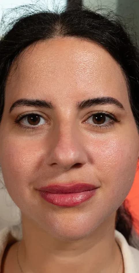 Fotona Rosacea Redness Reduction after treatment