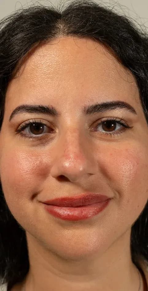 Fotona Rosacea Redness Reduction before treatment