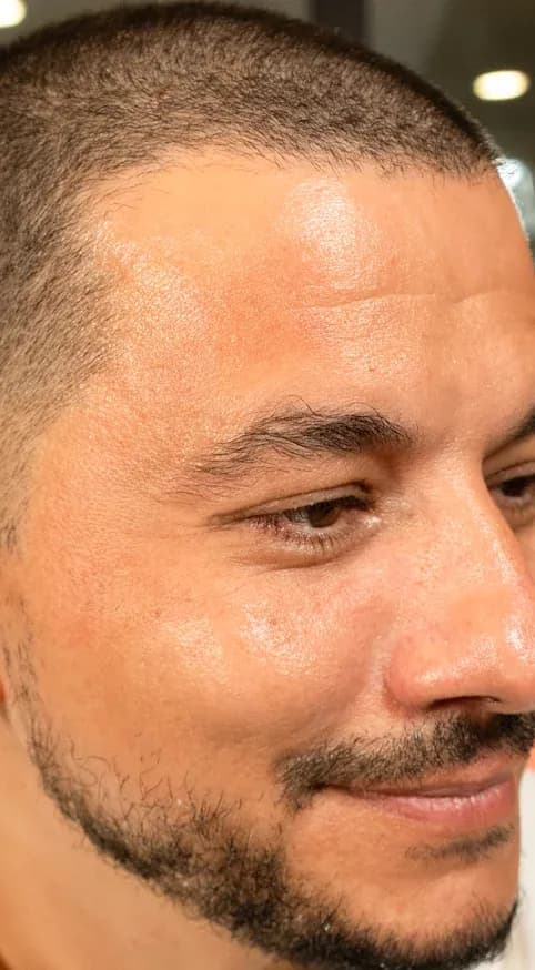 Fotona 7D Beard Area Tightening after treatment