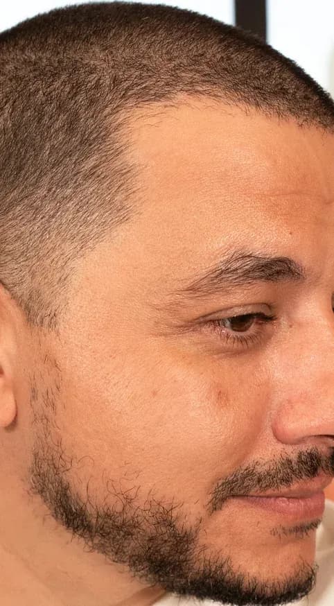 Fotona 7D Beard Area Tightening before treatment
