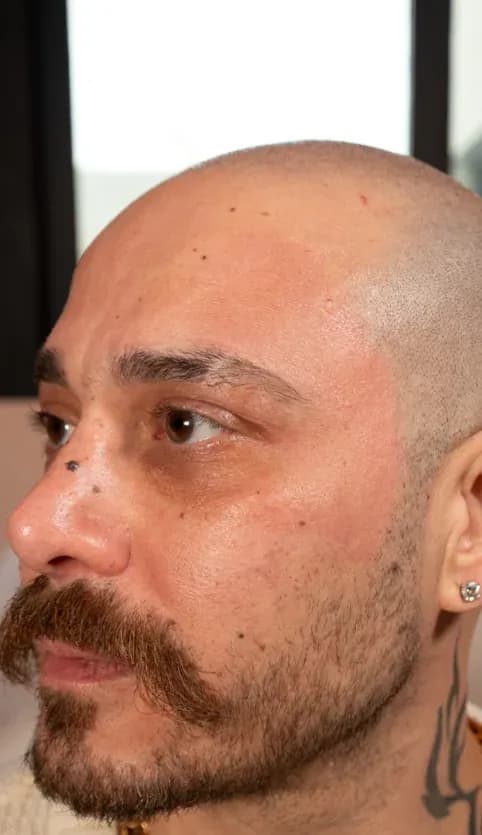 Fotona 7D Profile Tightening after treatment