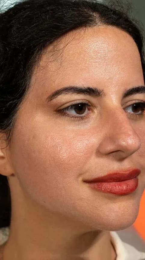 Fotona Rosacea Skin Calming after treatment