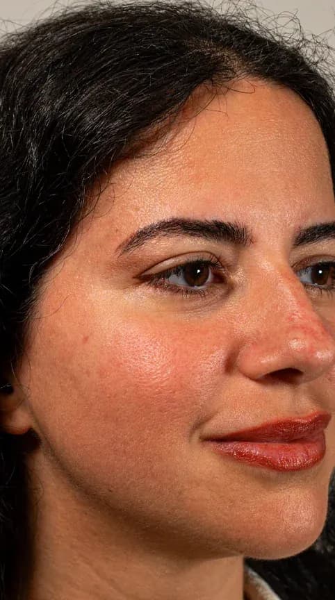 Fotona Rosacea Skin Calming before treatment