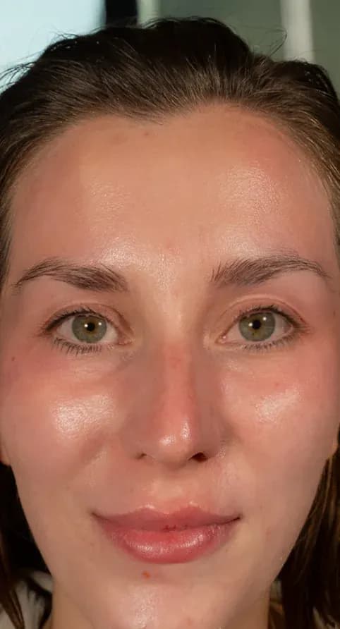 Fotona 7D Skin Tightening after treatment