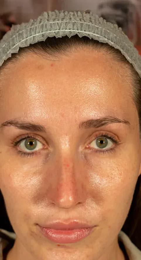 Fotona 7D Skin Tightening before treatment