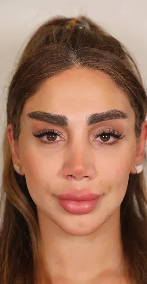 Korean 3D Lifting Result after treatment