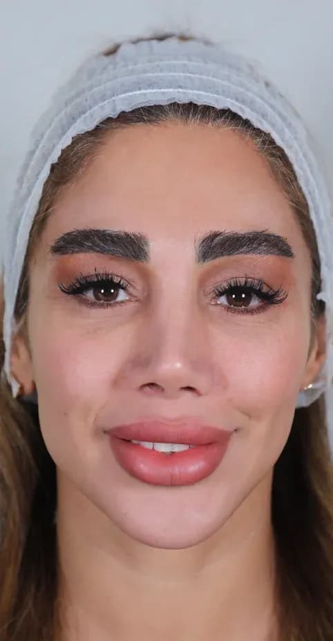 Korean 3D Lifting Result before treatment