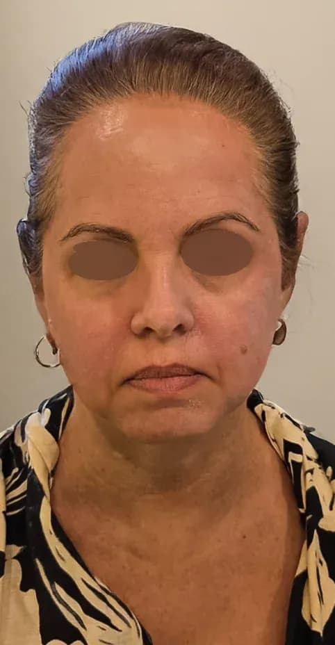 Fotona 7D Facial Firming after treatment