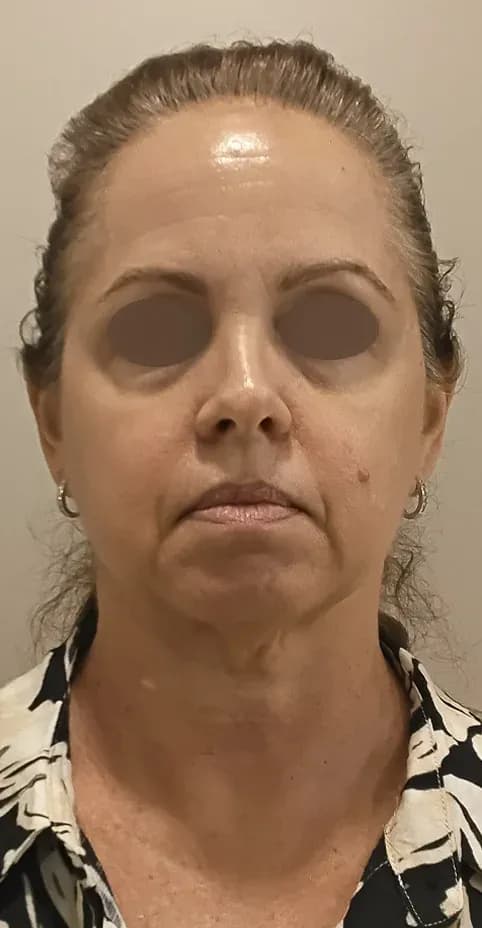 Fotona 7D Facial Firming before treatment