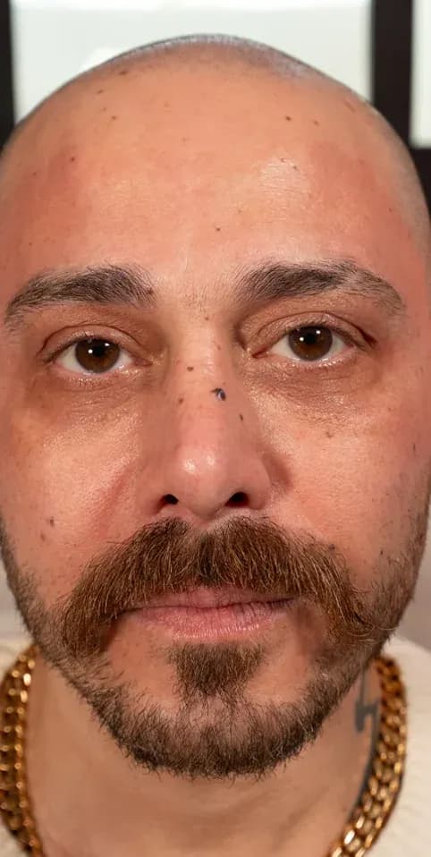 Fotona 7D Beard Line Rejuvenation after treatment