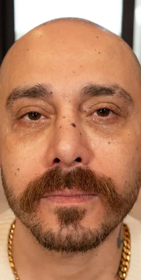 Fotona 7D Beard Line Rejuvenation before treatment