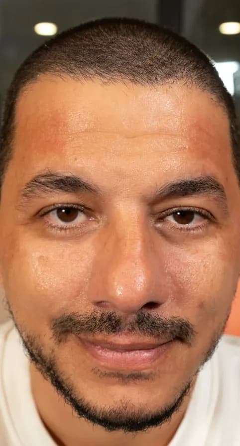 Fotona 7D Facial Symmetry Result after treatment
