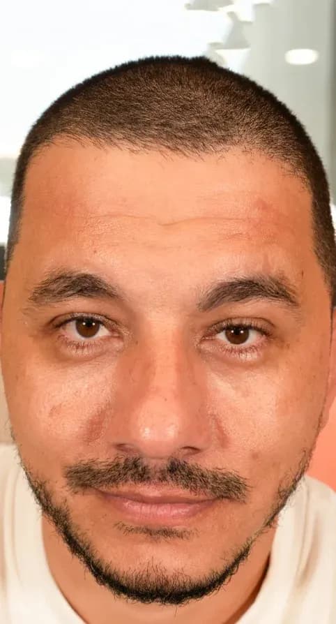 Fotona 7D Facial Symmetry Result before treatment