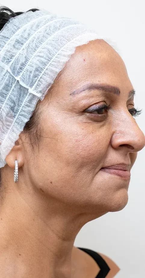 Korean Lift Face Refinement after treatment
