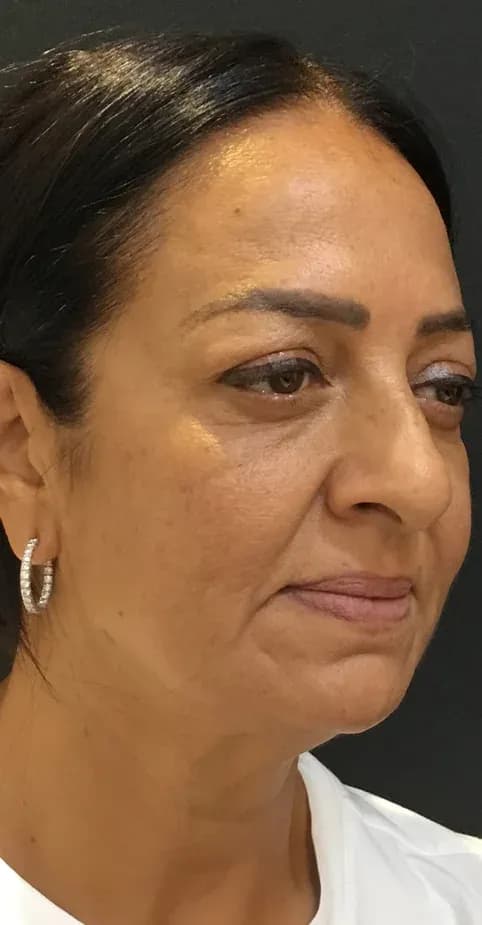 Korean Lift Face Refinement before treatment