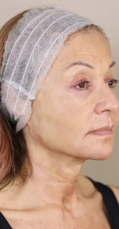Korean Lift Profile Smoothing after treatment