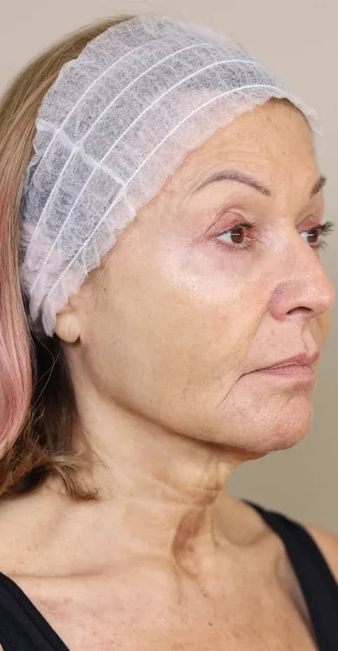 Korean Lift Profile Smoothing before treatment