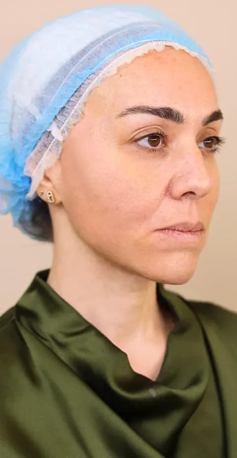 Korean Lift Facial Tightening after treatment