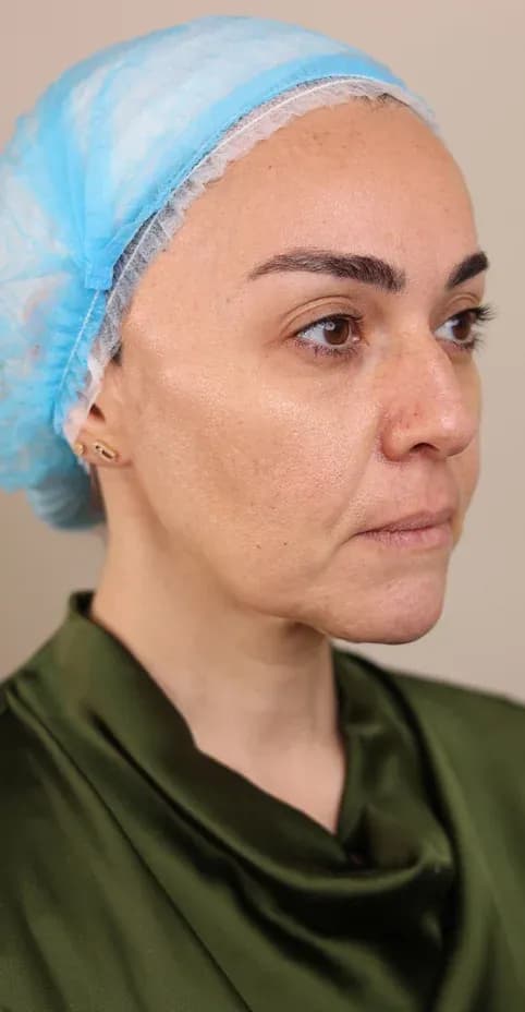 Korean Lift Facial Tightening before treatment