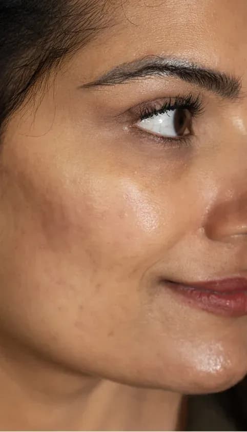 Scar Treatment Texture Improvement after treatment