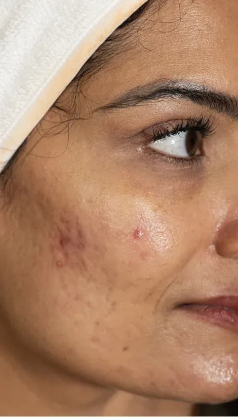 Scar Treatment Texture Improvement before treatment
