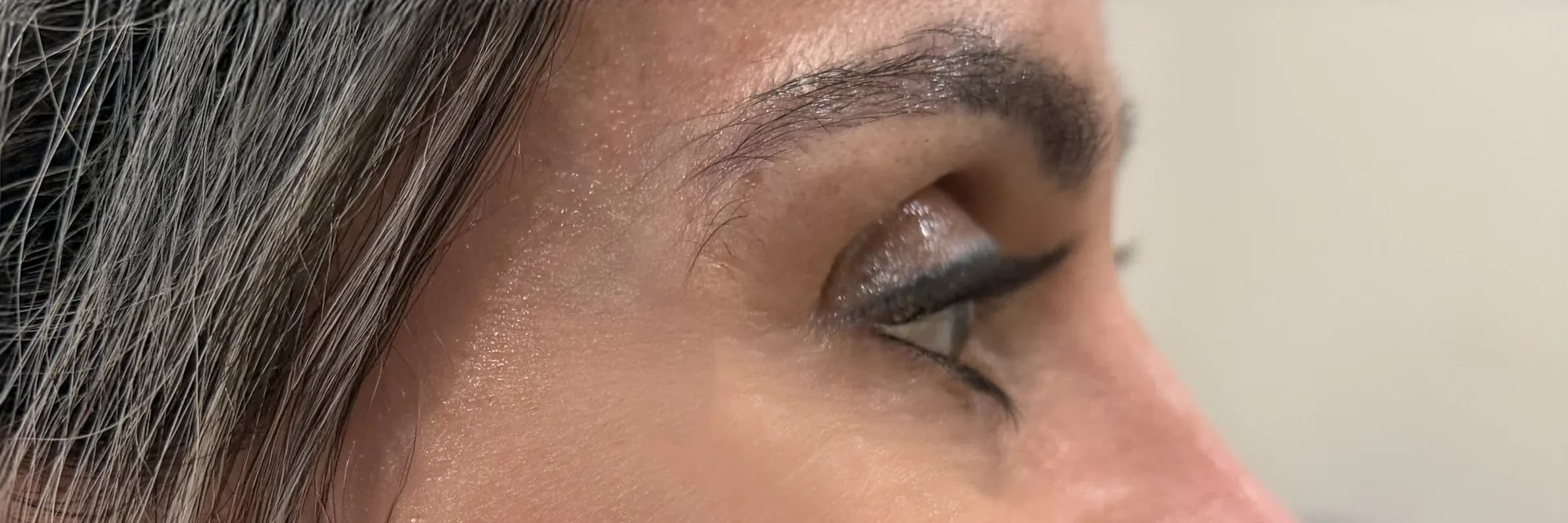 Fotona Angle Eye Rejuvenation after treatment