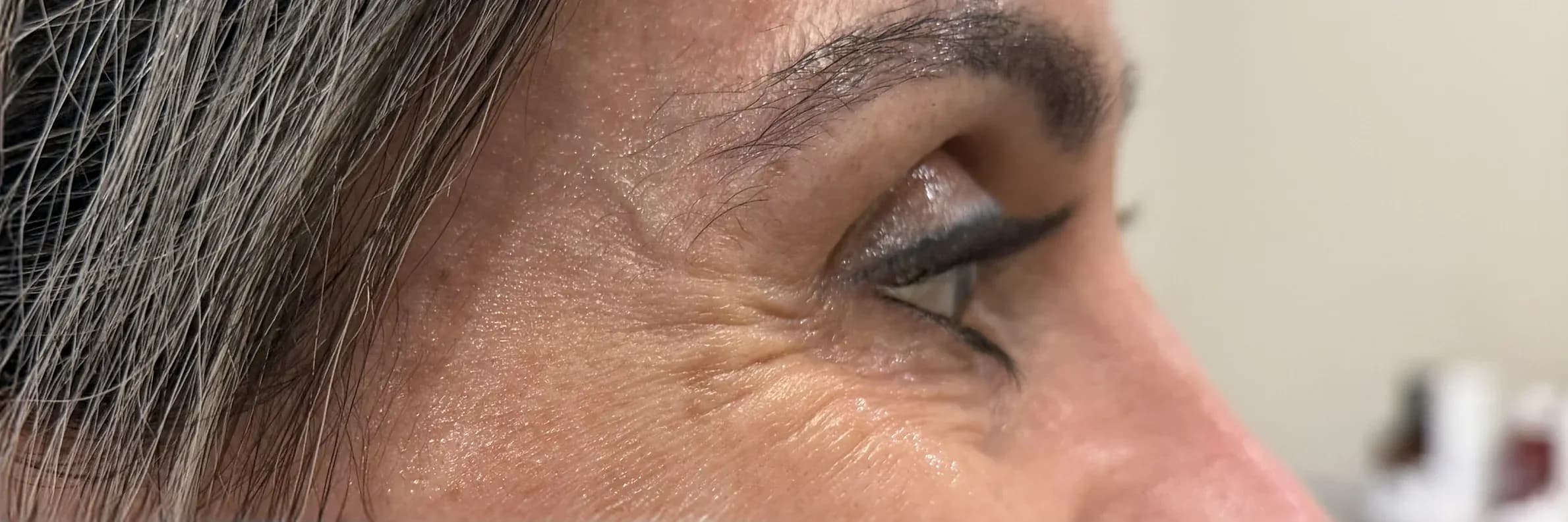 Fotona Angle Eye Rejuvenation before treatment