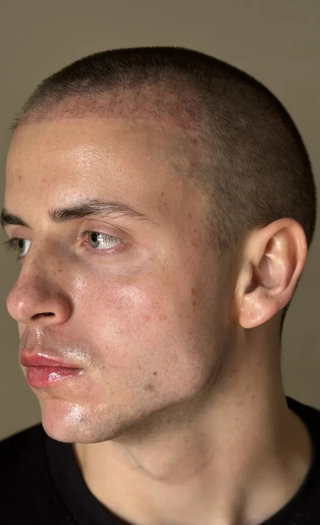 Face Contouring Profile Result after treatment