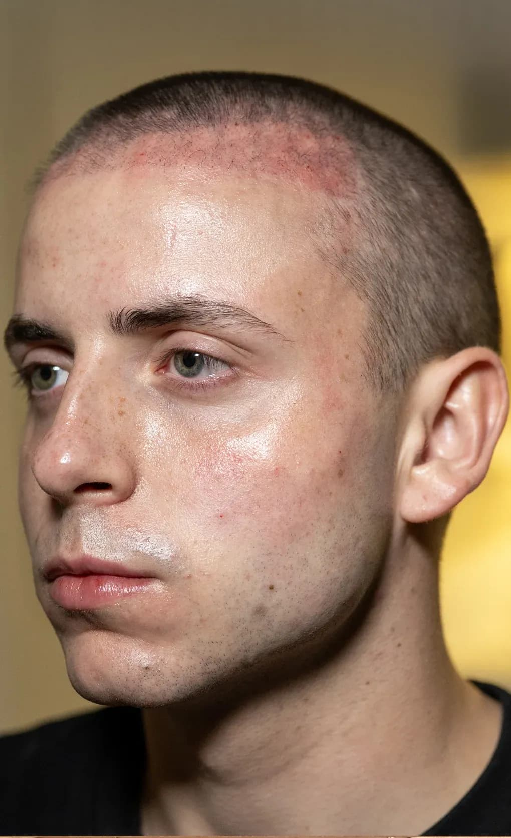 Face Contouring Profile Result before treatment