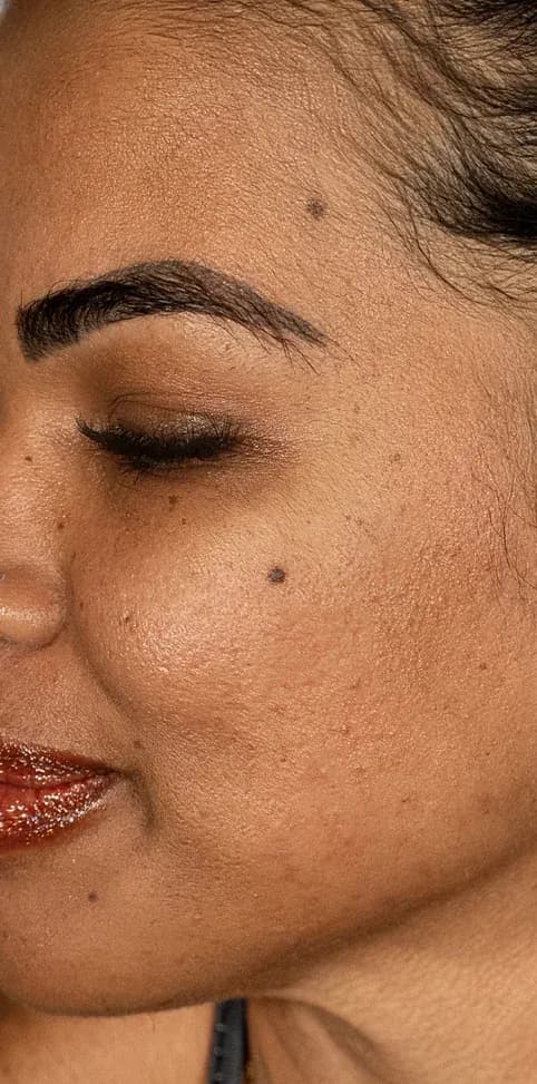 Scar Treatment Skin Texture Result after treatment