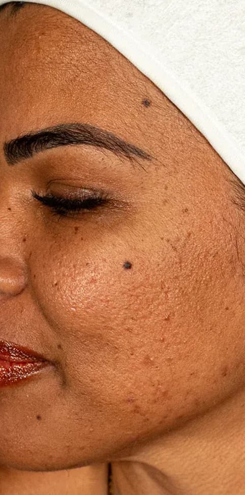 Scar Treatment Skin Texture Result before treatment