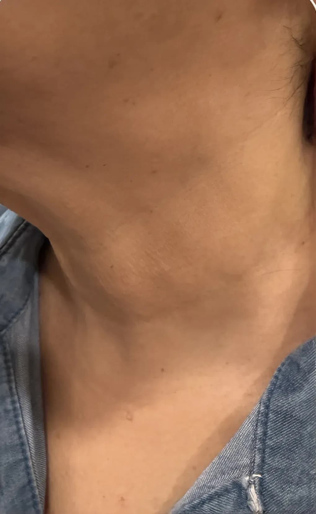 Fotona Neck Lifting Result after treatment